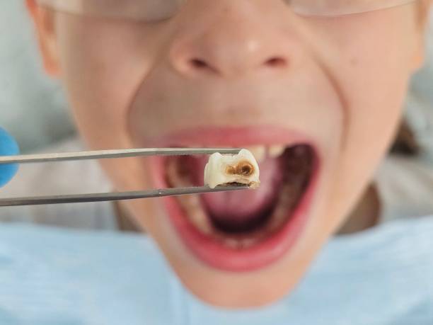 Best Pediatric Emergency Dentist in Lebanon, OR