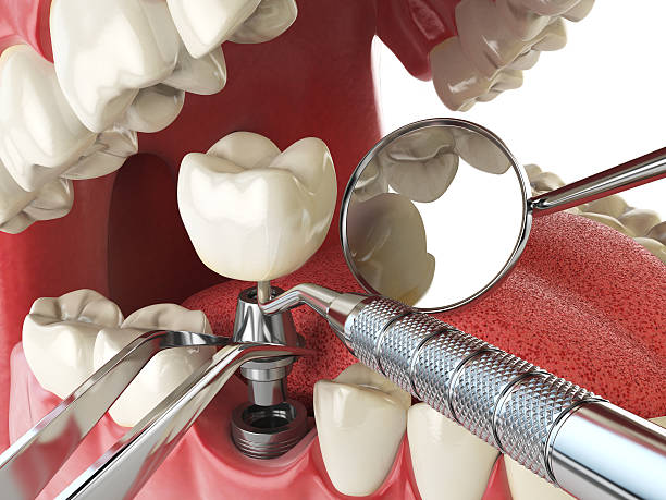 Best Emergency Root Canal Treatment in Lebanon, OR